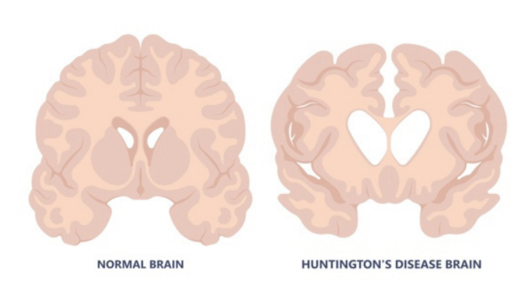 Graphic showing difference between normal brain and Huntington's brain